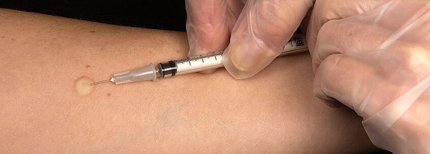 İntradermal Alerji Testi Nedir